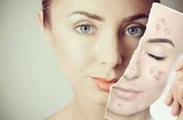 Ersatz von Botox